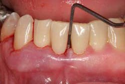 Perio Disease Fo Perio Disease Fo