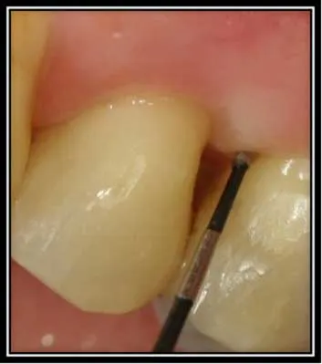 Enamel Projection Cervical Enamel Projection