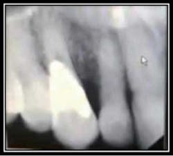 Postop Resorption 9 Postop Resorption 9