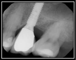 Preop Resorption 2 Preop Resorption 2