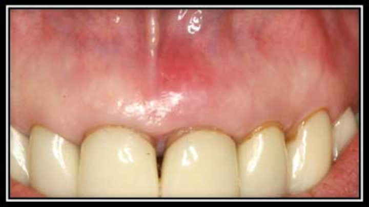 Pretreatment England Fo
