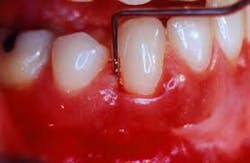 Probe Bleeding Fo Probe Bleeding Fo