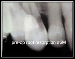 Radiographic Resoprtion 5 Radiographic Resoprtion 5