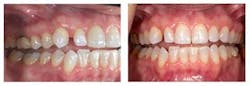 Ratcliffconvorthovsinvisalign Ratcliffconvorthovsinvisalign