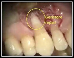 Repair Resorption 8 Repair Resorption 8