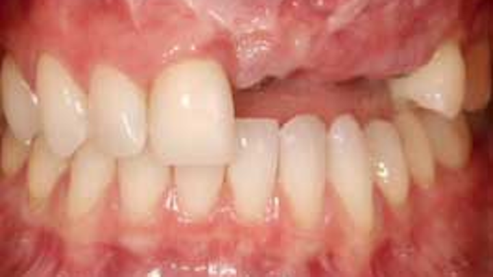 Replacemissingteethspear