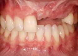 Replacemissingteethspear Replacemissingteethspear