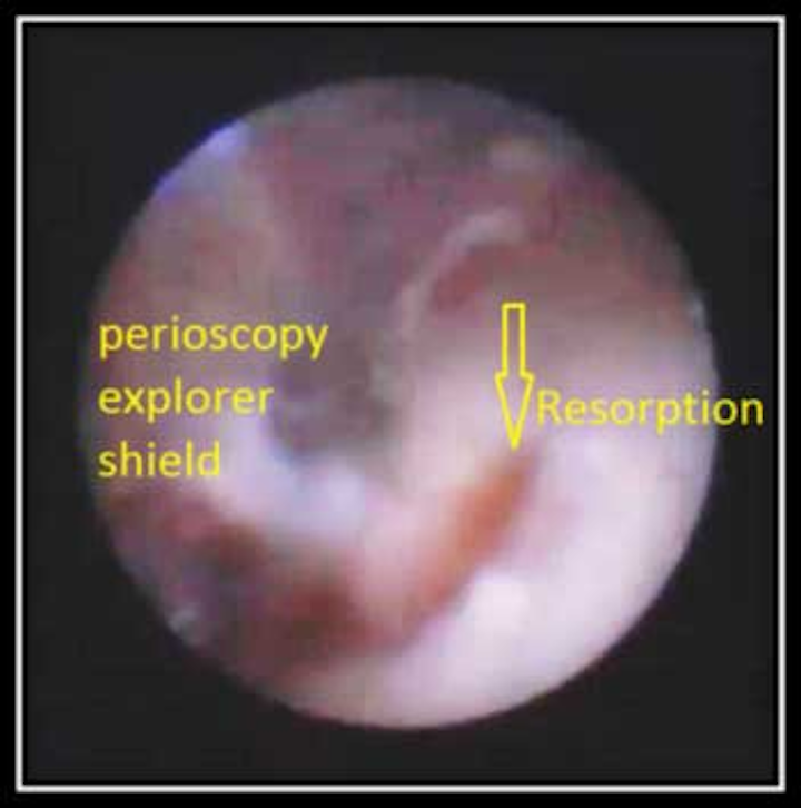 Resorption Fo