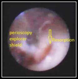 Resorption Fo Resorption Fo