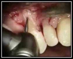 Retention Resorption 7 Retention Resorption 7