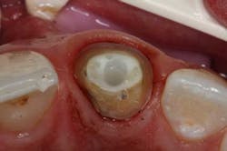 Rtd Fibercone Es Rtd Fibercone Es