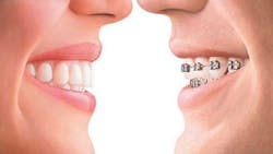 Sadri Aligner Therapy Vs Braces Sadri Aligner Therapy Vs Braces