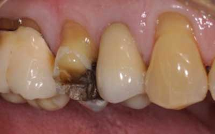 performing-a-one-minute-crown-buildup-dentistryiq