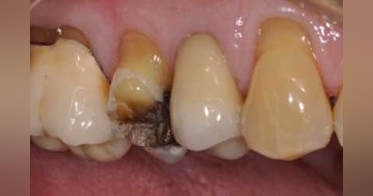 Performing a oneminute crown buildup Dentistry IQ