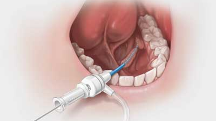 Sialendoscopy