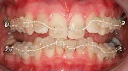 Sixmonthsmilespic Sixmonthsmilespic