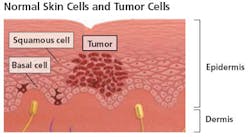 Skin Tumor Cells390 Fo