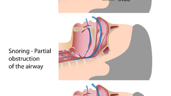 Sleep Apnea Dreamstime For Web