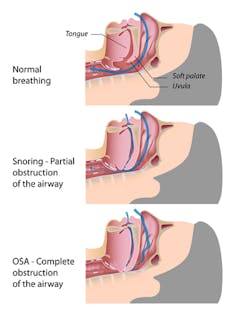 Sleep Apnea Dreamstime For Web Sleep Apnea Dreamstime For Web