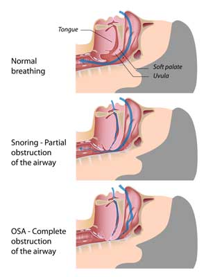 snoring