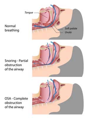 Help with clearance snoring