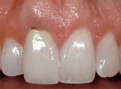 Spearantimp Spearantimp