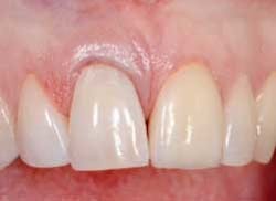 Spearimmedtemp2 Spearimmedtemp2