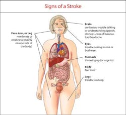 Stroke Signs Fo Stroke Signs Fo