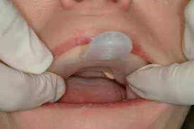 Taking Impressions With Jaw Pain