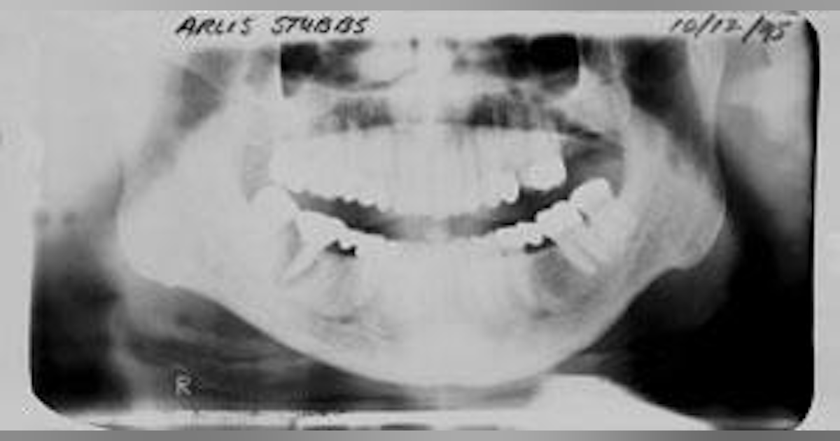 Bone Regeneration in periodontal defects, ridge augmentation, and in ...