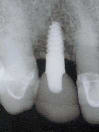 Th 0506dem Immed20 Th 0506dem Immed20