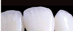 Th 0509dem Allveneers03 Th 0509dem Allveneers03
