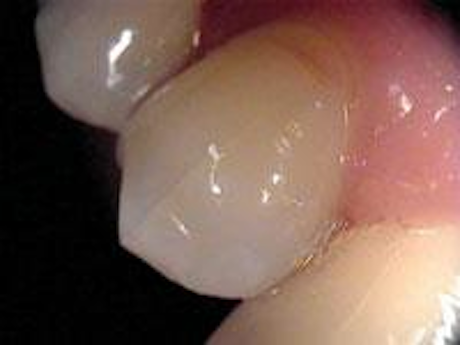 Cracked Tooth Syndrome Dentistry IQ cracked-tooth-syndrome-dentistry-iq