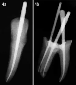 Introducing the Activ GP Precision Obturation System | Dentistry IQ