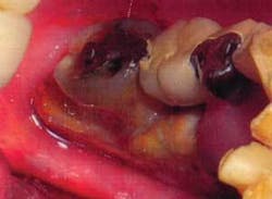 Th 0703wdjnecrosis01 Th 0703wdjnecrosis01