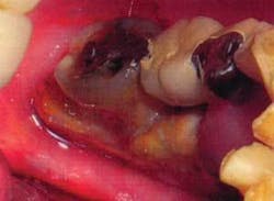 Th 0703wdjnecrosis01 Th 0703wdjnecrosis01