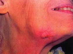 Th 0703wdjnecrosis02 Th 0703wdjnecrosis02