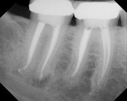 Th 0709do Rootcanal04 Th 0709do Rootcanal04