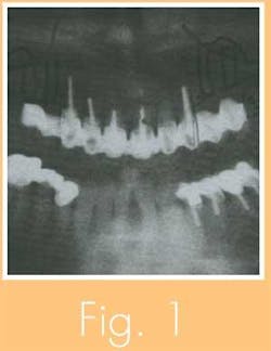 Th 0711wdjimplant02 Th 0711wdjimplant02