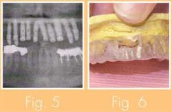 Th 0711wdjimplant04 Th 0711wdjimplant04