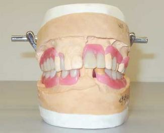 Valplast Denture Base : They Are A Prescription Only Product And Your Dentist Can.
