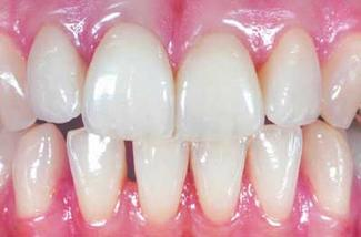 Choosing The Right Material For Anterior Restorations Dentistryiq