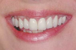 Choosing The Right Material For Anterior Restorations Dentistryiq