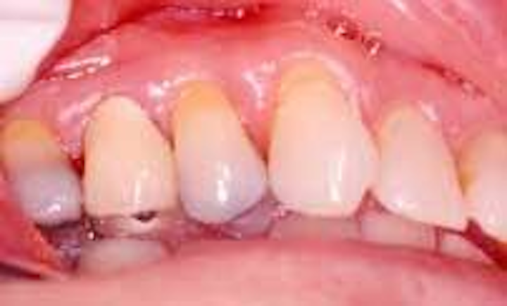 Smoking And Periodontitis Dentistryiq