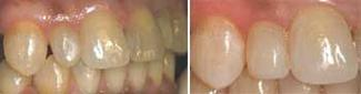 Using composite resin restorative materials; Part I Dentistry IQ
