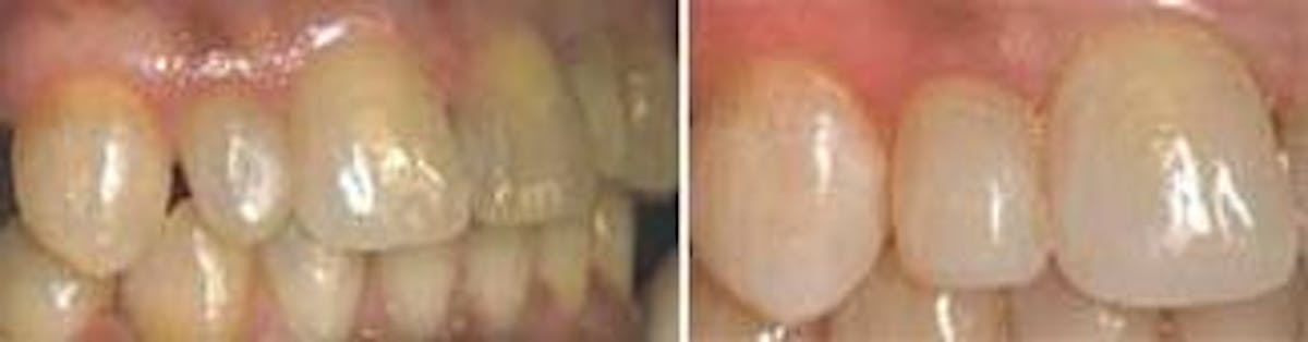 Dental Light Cure Bonding Adhesive/Acid Etching Gel/Composite Resin Curing  Light