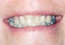 SingleTooth Implant Treatment in the esthetic zone Dentistry IQ