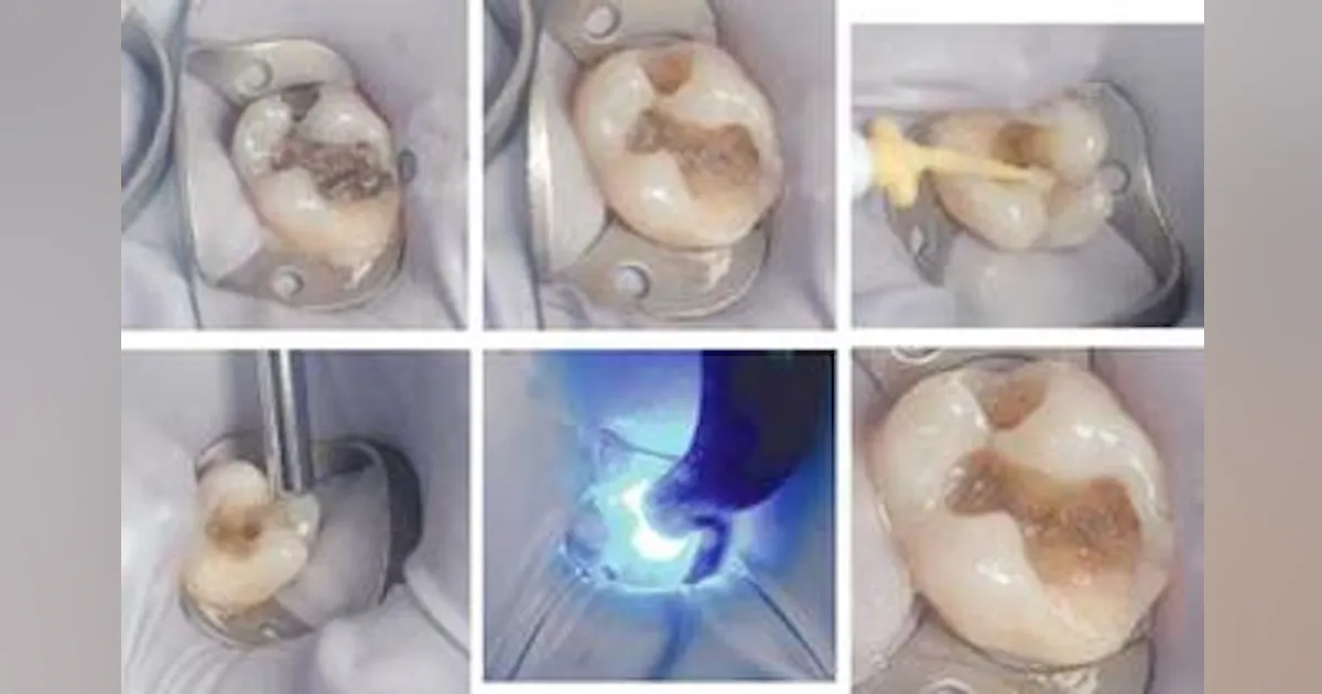 A closer look at Gradia Direct | Dentistry IQ