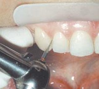 Minor Tooth Movement (MTM) Alignment