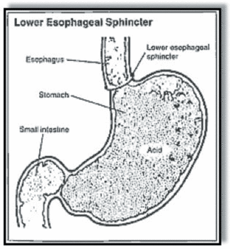 Understanding Acid Reflux And Its Dental Manifestations Dentistryiq acid reflux and its dental